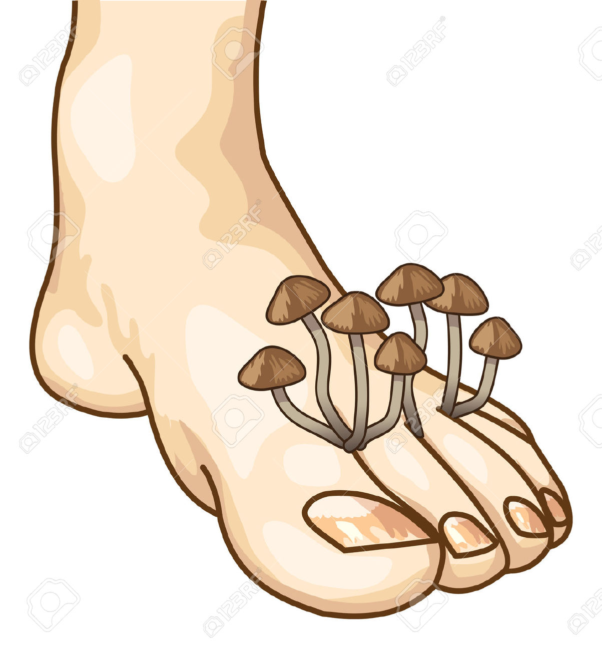 Fungal infection clipart - Clipground
