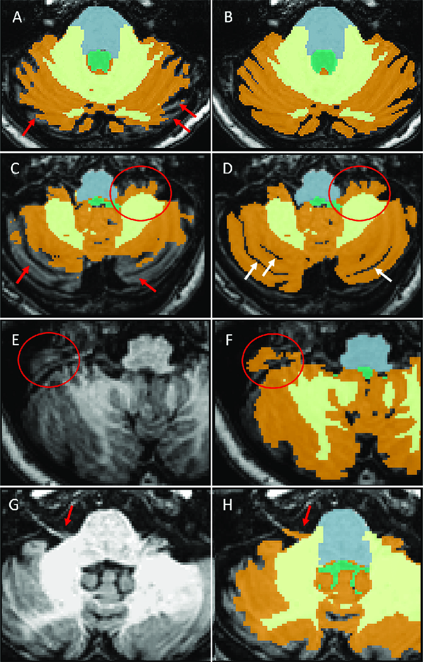 Manual editing of Freesurfer automated segmentation. A.