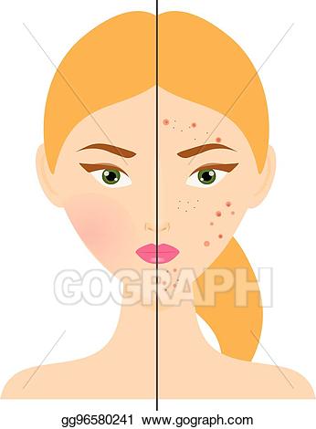 acne clip art 20 free Cliparts | Download images on Clipground 2021