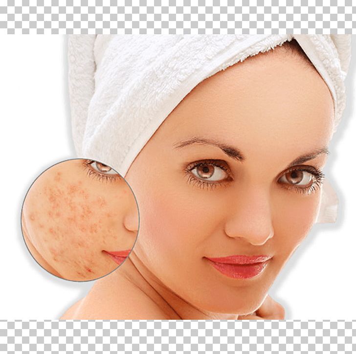 Scar Acne Pimple Dermatitis Skin PNG, Clipart, Acne, Beauty, Burn.