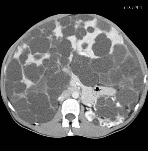 Autosomal dominant polycystic kidney disease.