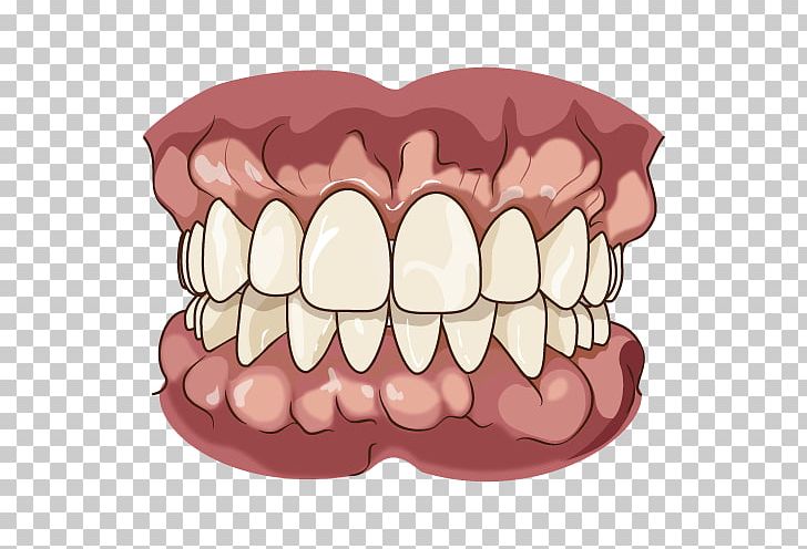 Tooth Jaw Dentures Chewing Bruxism PNG, Clipart, Alveolar.