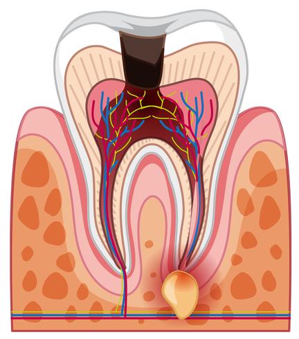 A Human Tooth Decay and Cavity.