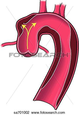 Clip Art of Location of dissecting aneurysm of aorta: type 1.