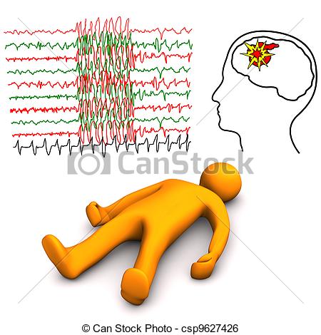 Stock Illustration of Apoplectic And Epileptic Stroke.