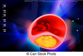 Apoplectic Stock Illustration Images. 15 Apoplectic illustrations.