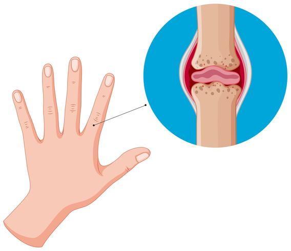 Human hand and bad joints, arthritis.