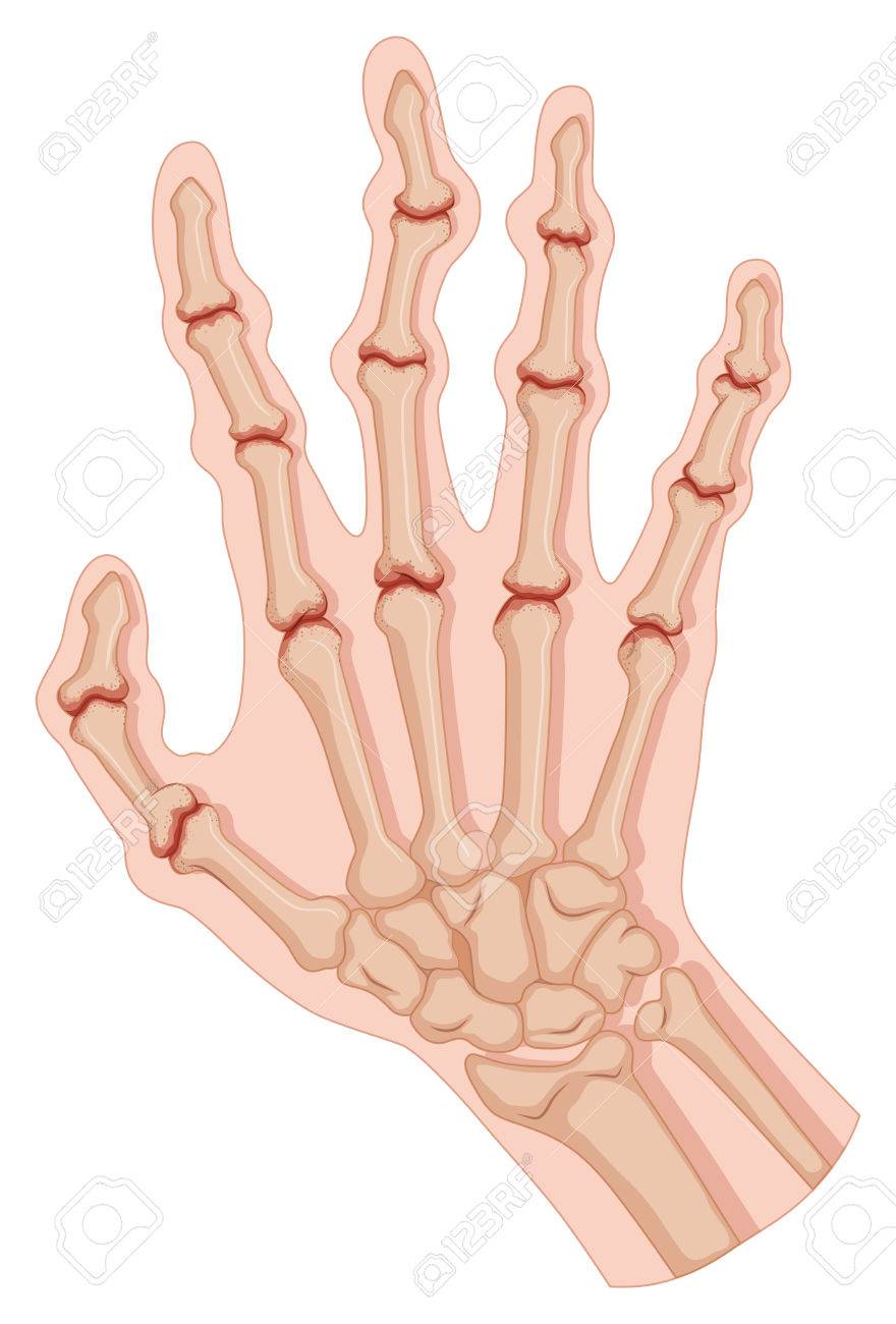 Rheumatoid arthritis in human hand illustration.