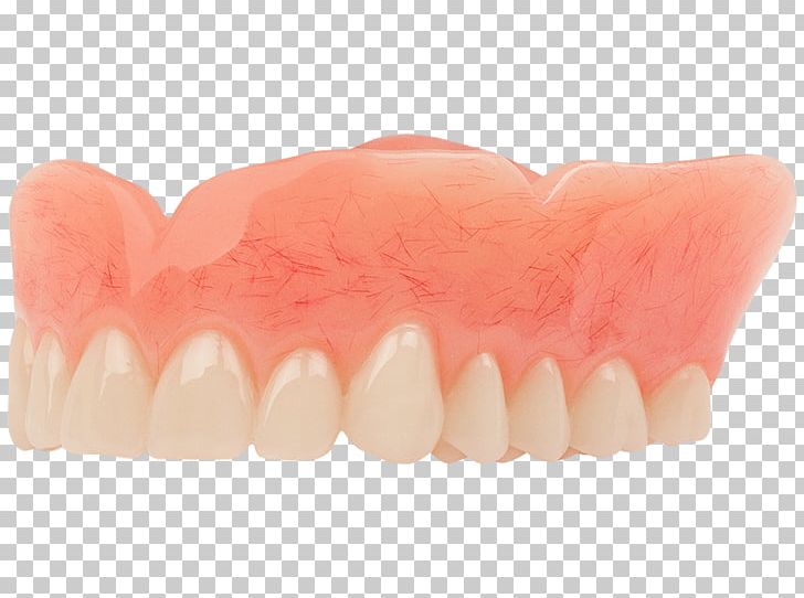 Tooth Dentistry Dentures Aspen Dental PNG, Clipart, Aspen.