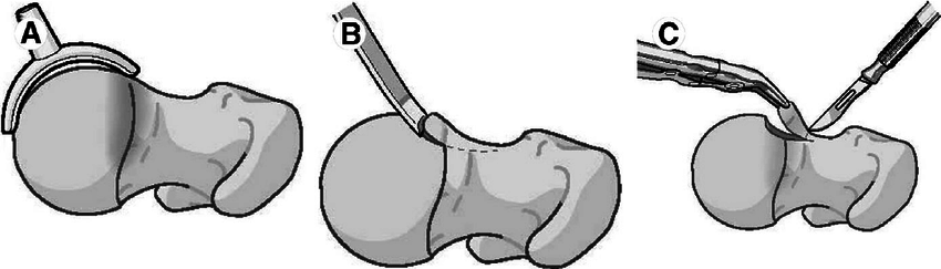 Femoral correction usually involves trimming of the.
