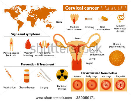 Kidney Stone Medical Infographic Set Elements Stock Vector.
