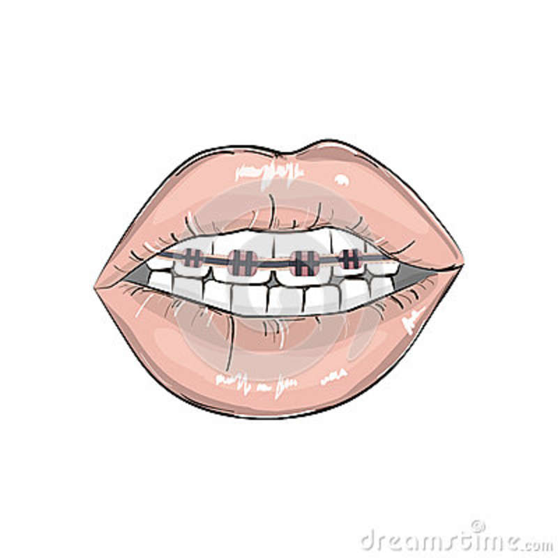 braces cartoon clipart 20 free Cliparts | Download images on Clipground ...