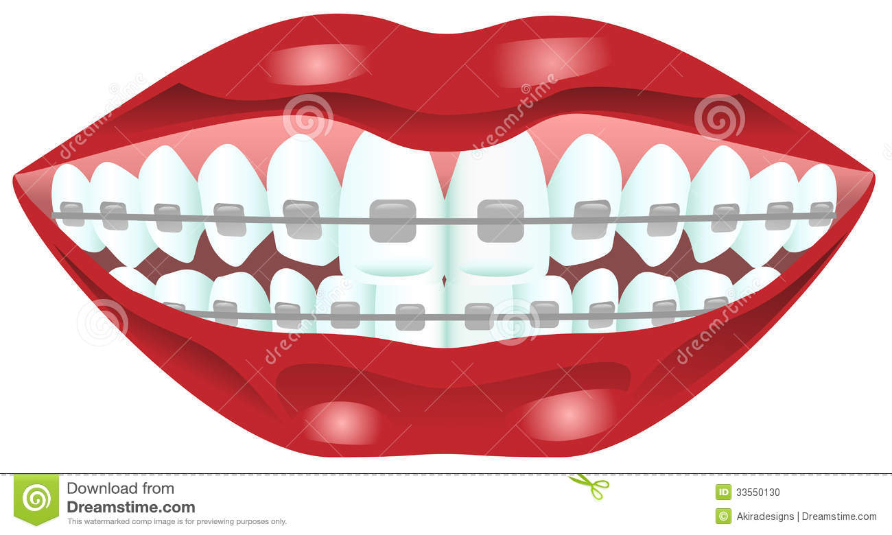 Download Braces clipart 20 free Cliparts | Download images on ...