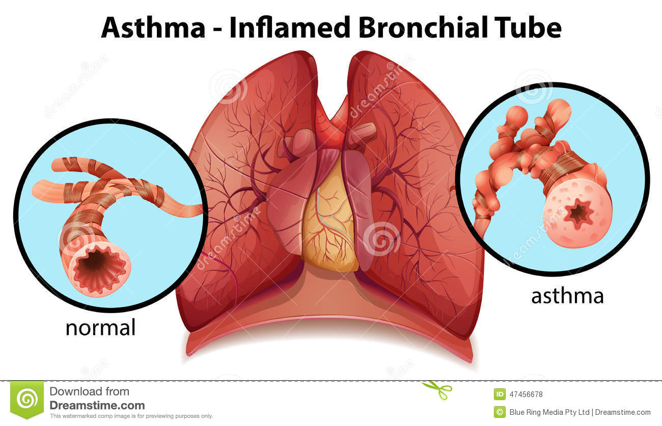 An Asthma.