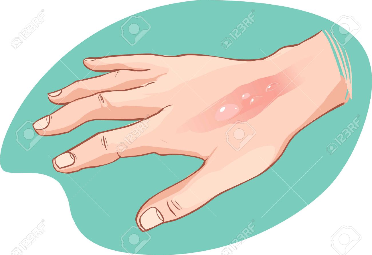 Burned hand clipart 2 » Clipart Station.