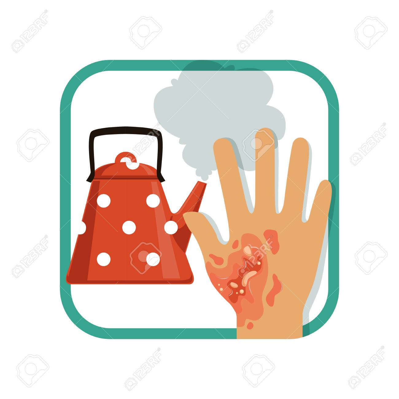 Illustration showing third degree burn of hand. Severe burns...