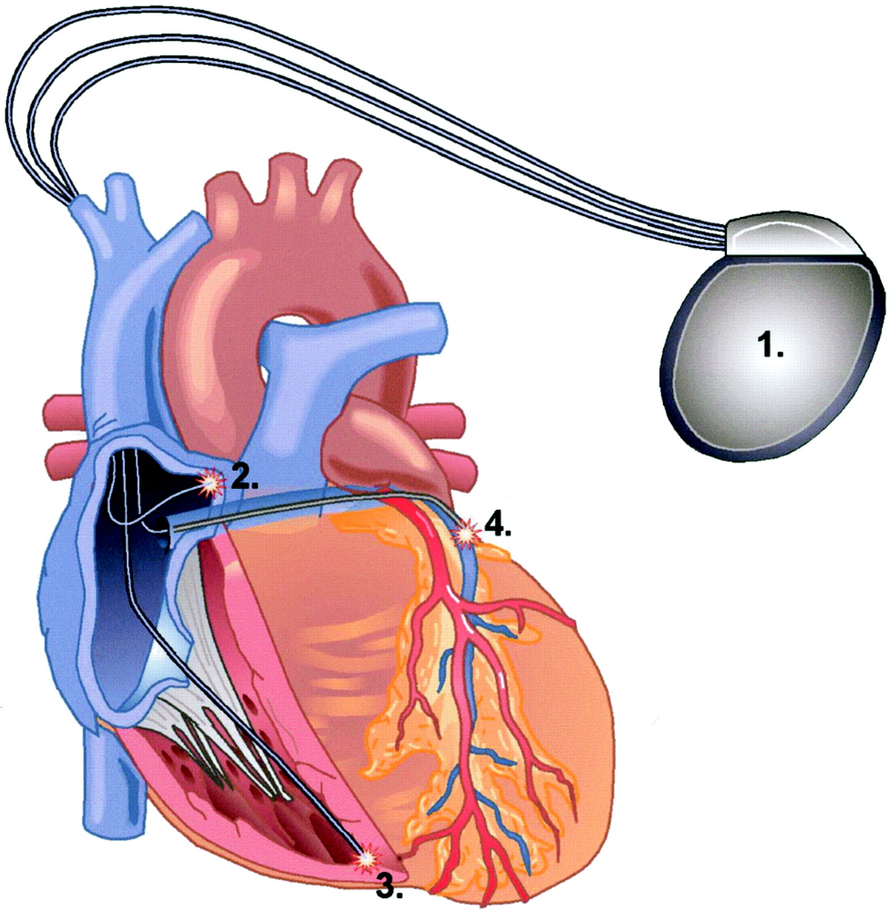 Cardiac pacemaker clipart 20 free Cliparts | Download ...