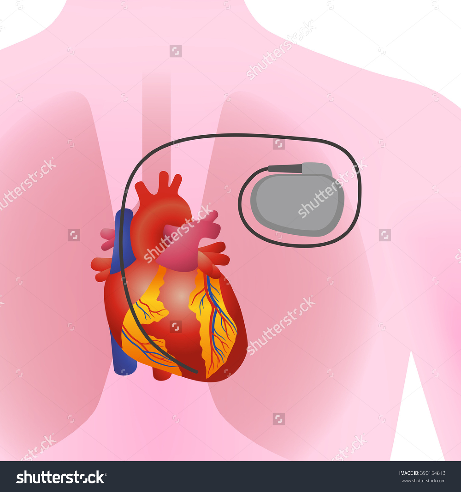 Сколько живут с кардиостимулятором. Электрокардиостимулятор. Кардиостимулятор и сердце Графика. Кардиостимулятор детям. Кардиостимулятор сердца на человеке.