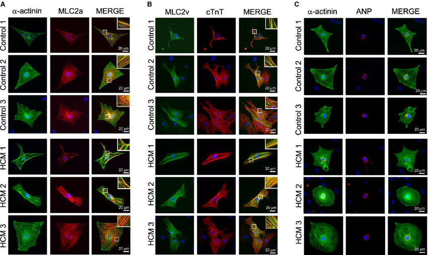 Cardiomyocyte generation from control and HCM iPSCs. The.