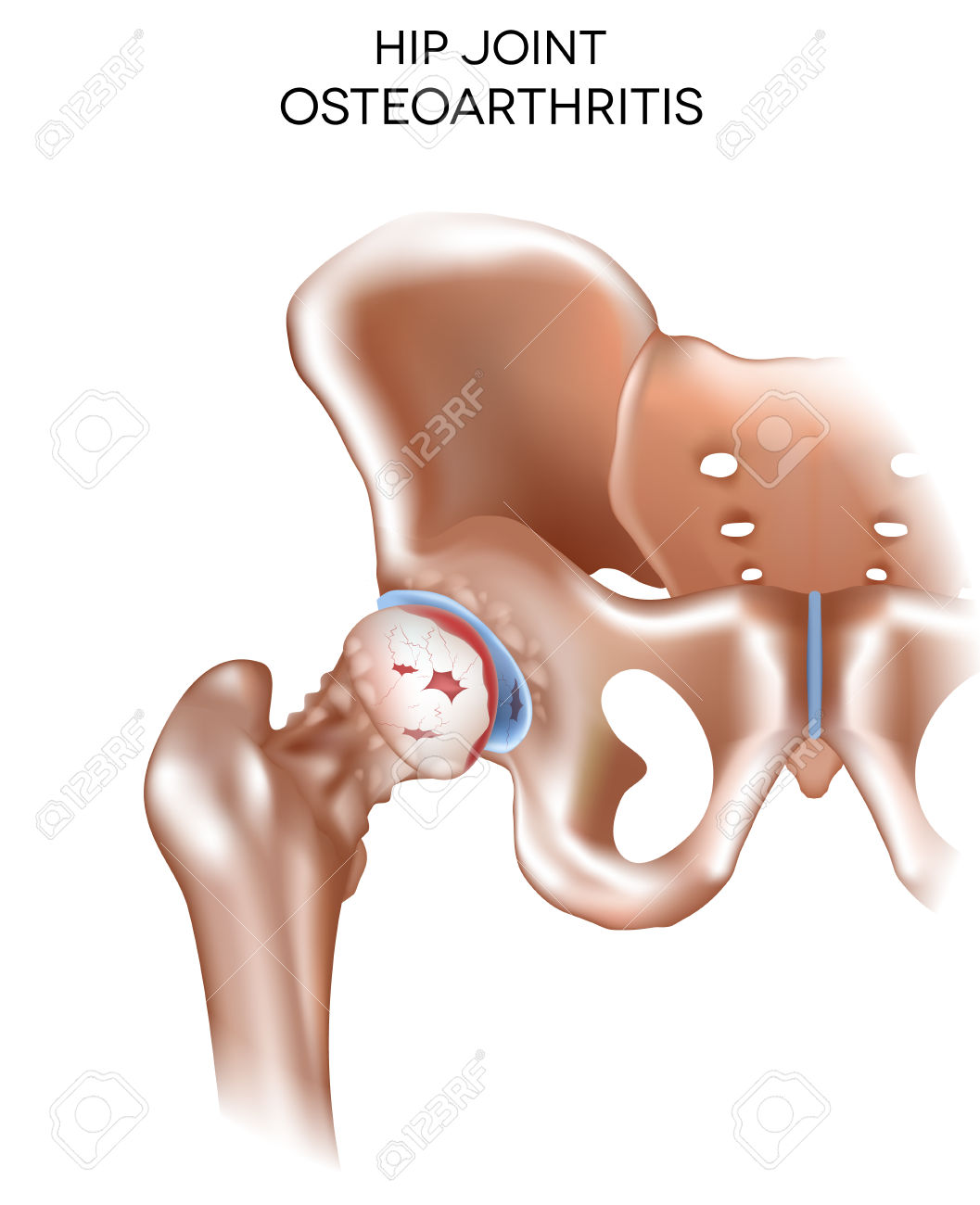 Arthritis Of The Hip Joint, Damaged Joint Cartilage And.
