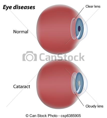 Clipart Vector of Eye disease cataract, eps8.
