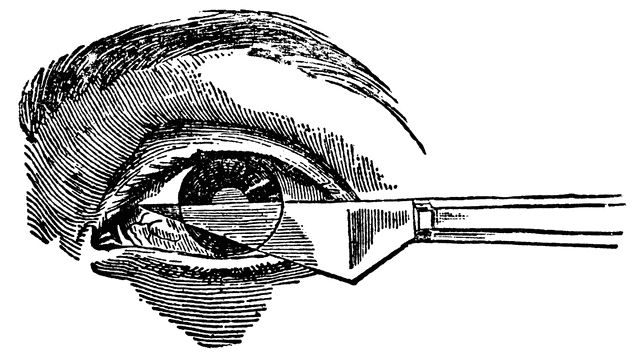Cataract Operation.
