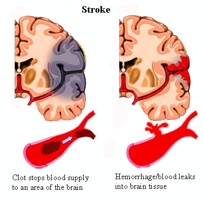The Clinical Practice of Chinese Medicine: Stroke & Parkinsons.