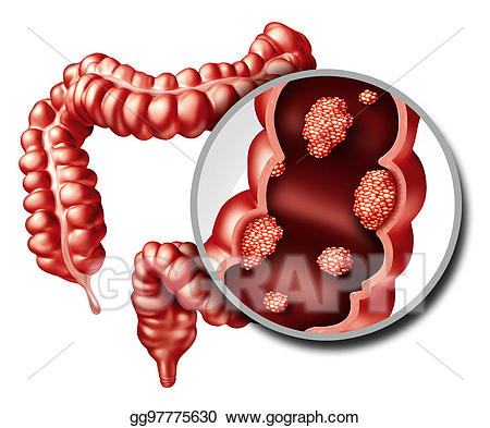 clipart tumor 10 free Cliparts | Download images on Clipground 2022