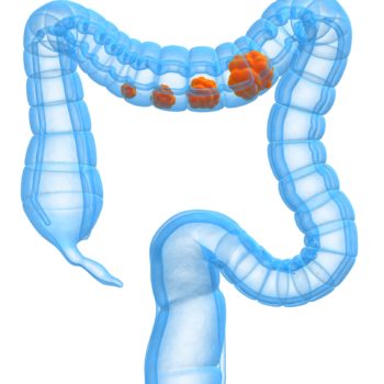 colon cancer clip art 20 free Cliparts | Download images on Clipground 2024