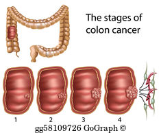 Colon Cancer Clip Art.