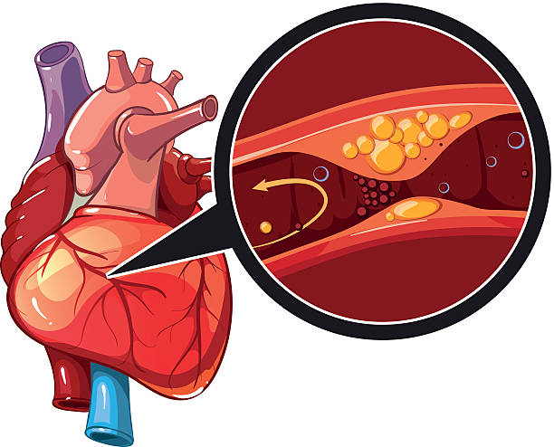 coronary artery disease clipart 10 free Cliparts | Download images on ...