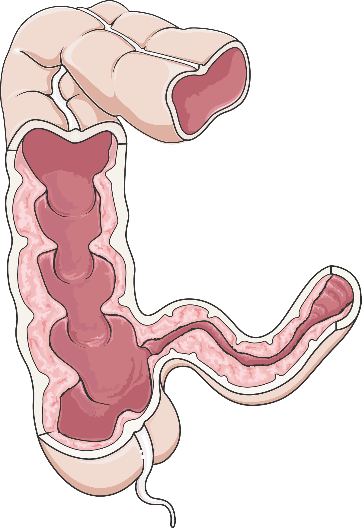 Colon (Crohn's disease).