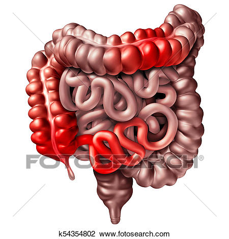 Crohn's Disease Drawing.