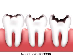 Demineralization Vector Clipart EPS Images. 17 Demineralization.