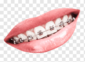 Dental Braces cutout PNG & clipart images.