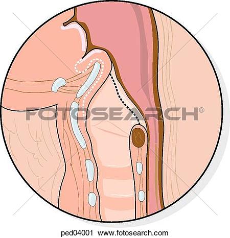 Clipart of Sagittal view of pharyngeal area showing enlarged and.