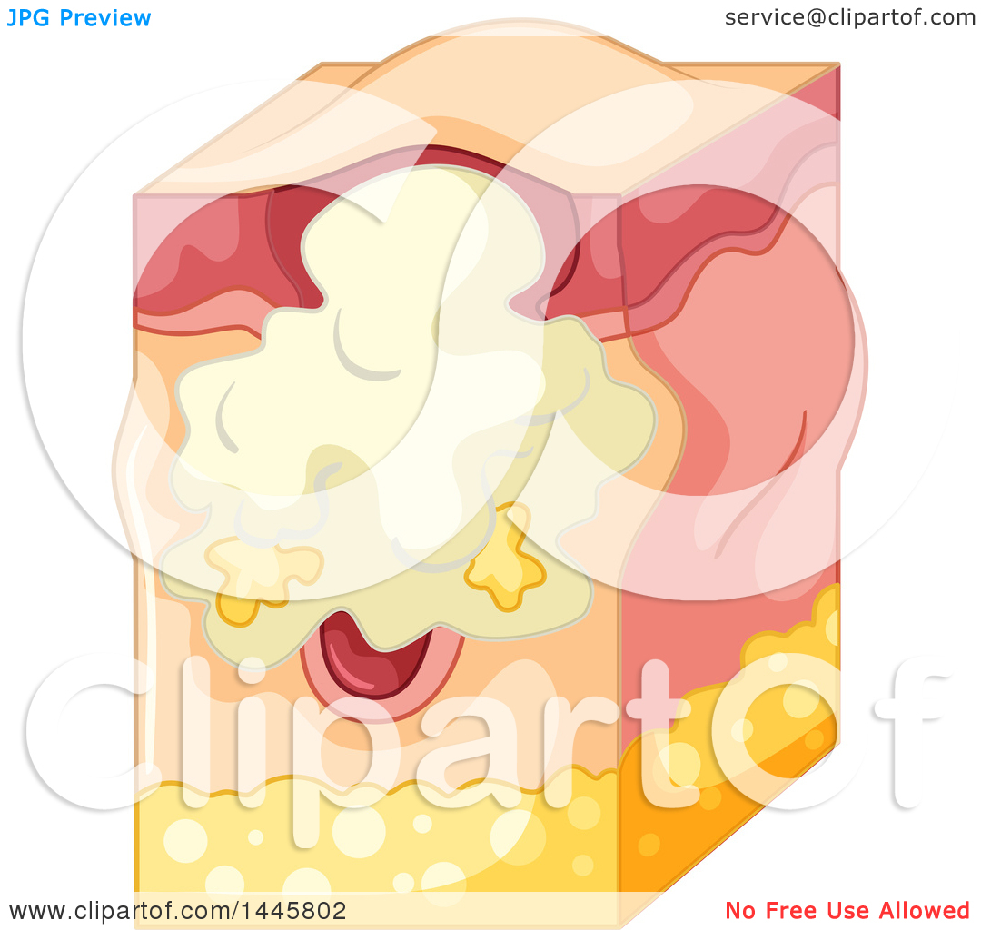 Clipart of a Medical Diagram of an Infected Pimple in the.
