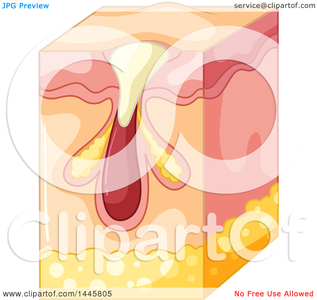 Clipart of a Medical Diagram of a Forming Pimple in the Epidermis.