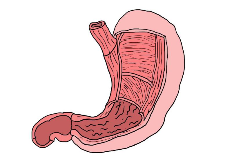 É possível curar o cancro do estômago? As explicações de um médico.