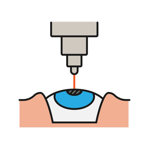 Best Eye Surgery Illustrations, Royalty.