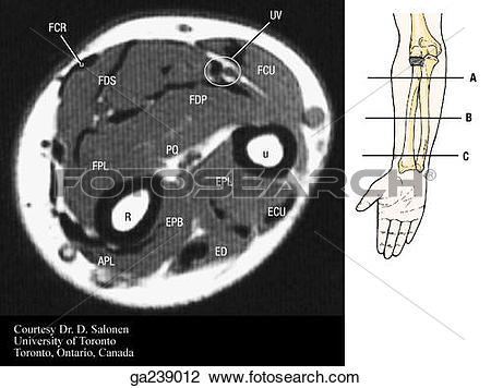 Clip Art of Transverse MRI of forearm: FCR/FCU, flex. carpi rad.
