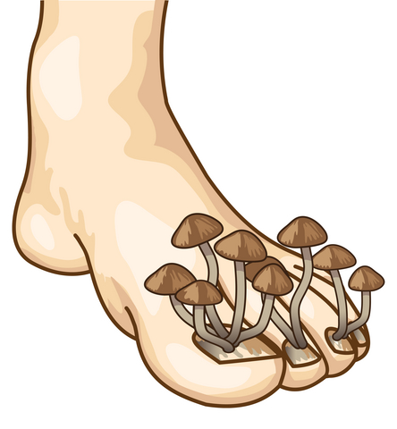 Everything You Need To Know About Toenail Fungus.