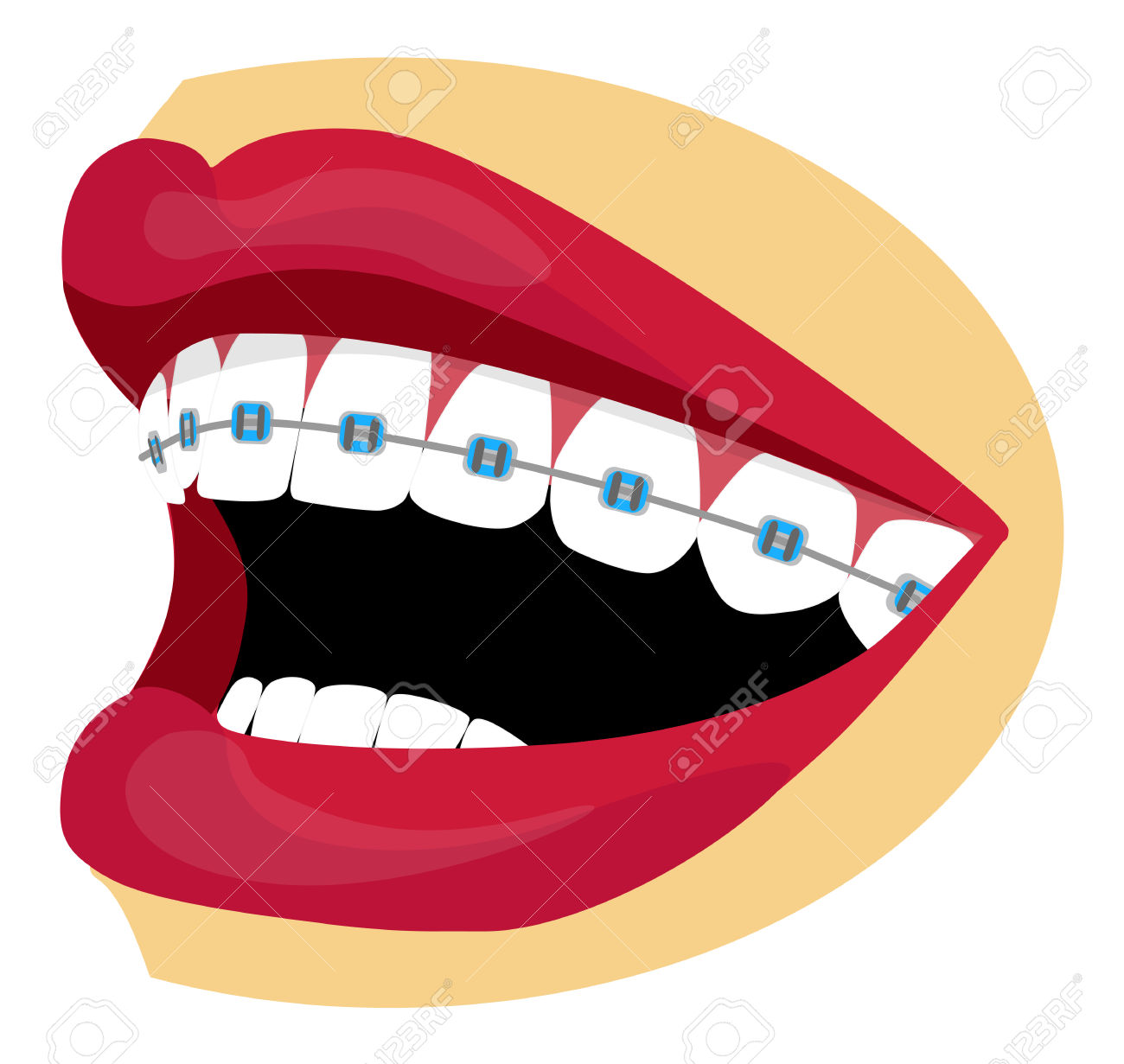3,552 Braces Cliparts, Stock Vector And Royalty Free Braces.