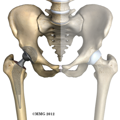 Download Free png Artificial Joint Replacement of the Hip, Anterior.