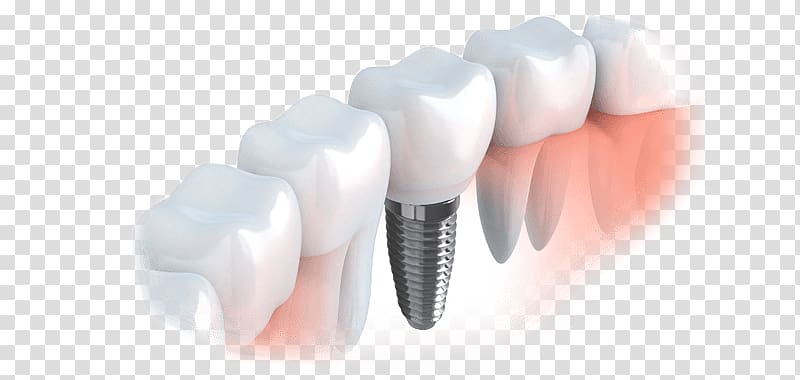 Dental implant Restorative dentistry Oral hygiene, crown transparent.
