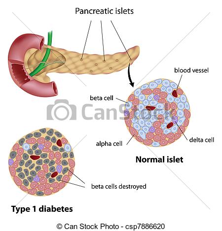Vector Clipart of Pancreatic islet in diabetes, eps8.