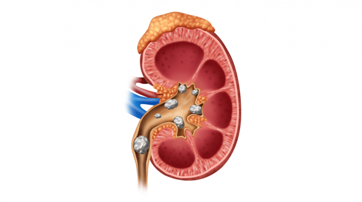 Kidney Stones: Some Key Things to Prevent the Problem.