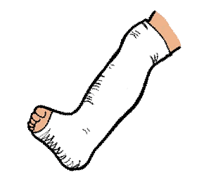 Download Free png How to Measure Leg Cast.