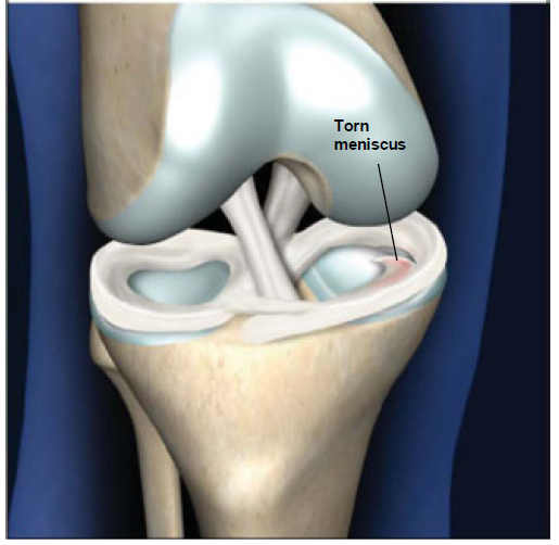torn meniscus ct scan clipart Tear of meniscus Anterior.