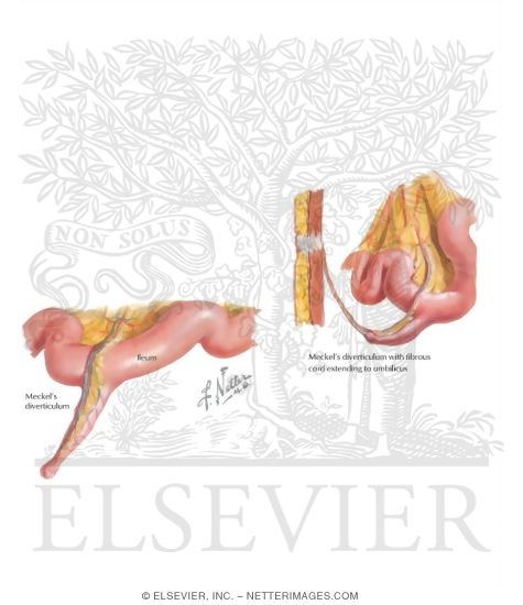 Diverticulum.